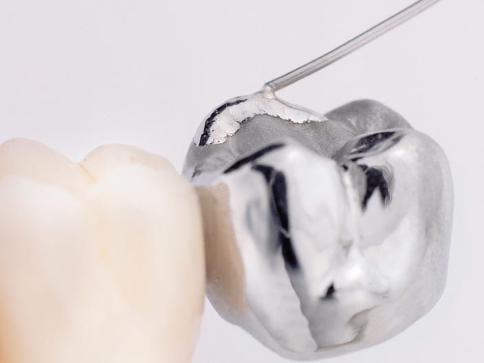 Laser Welding in an Orthodontic Laboratory